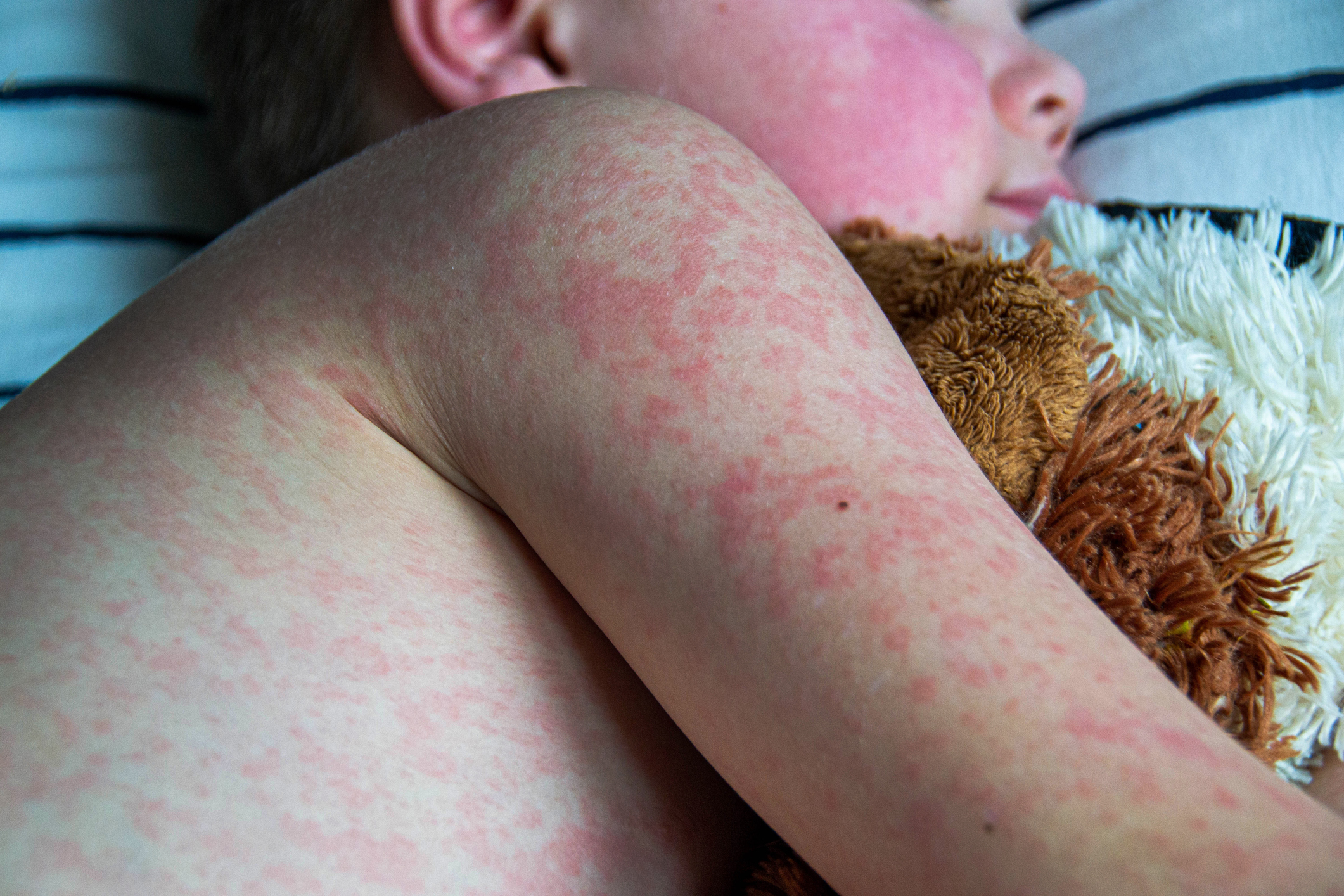 small child with measles rash