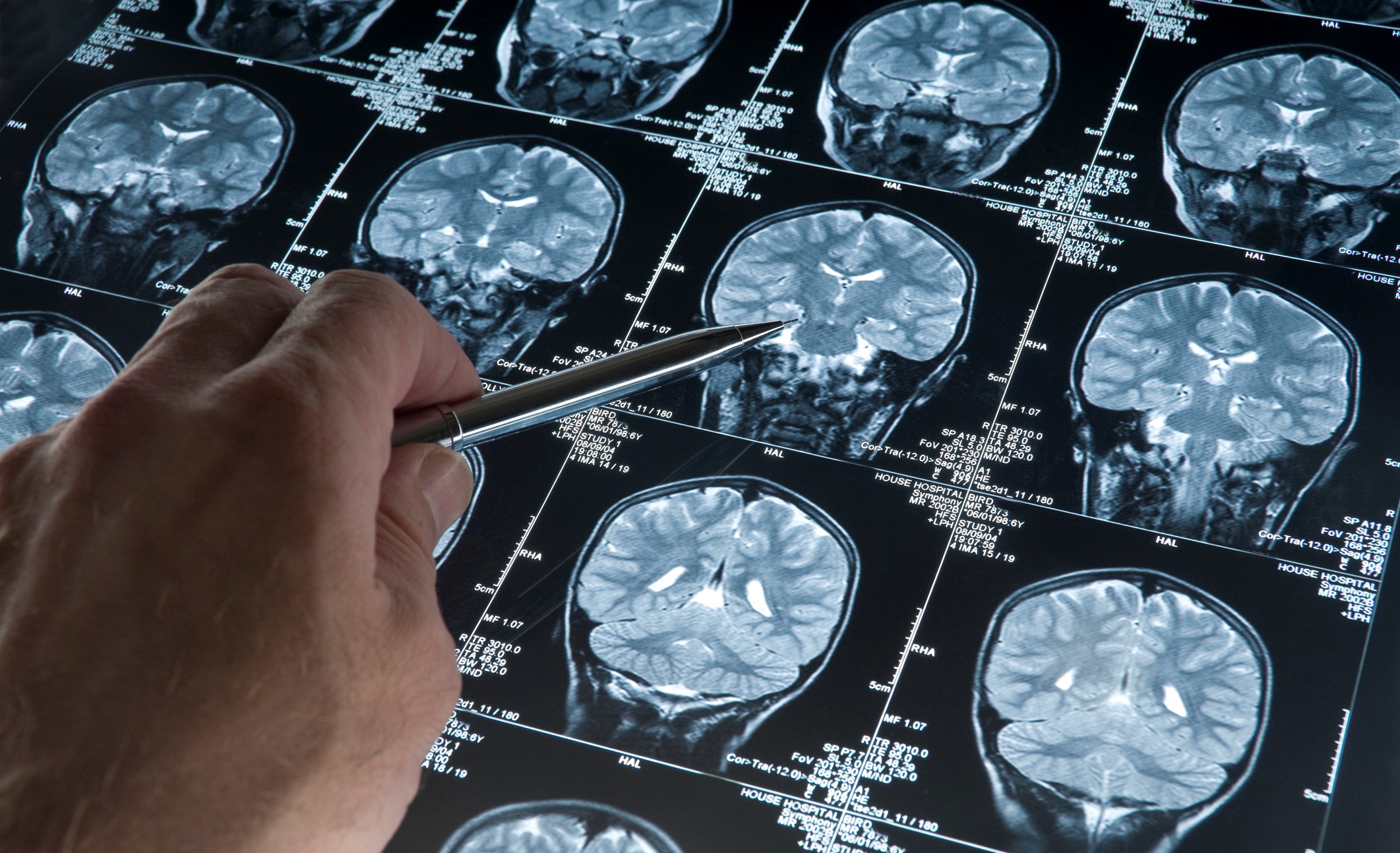 Person's hand holding a pen, pointing at a brain scan image
