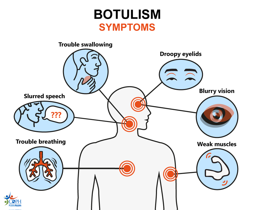 Botulism symptoms include trouble swallowing, droopy eyelids, blurry vision, slurred speech, weak muscles, and trouble breathing