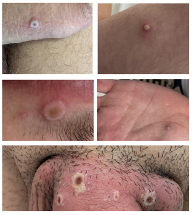 monkeypox lesions