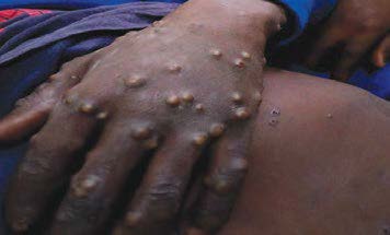 Vesiculopapular-rash-of-monkeypox