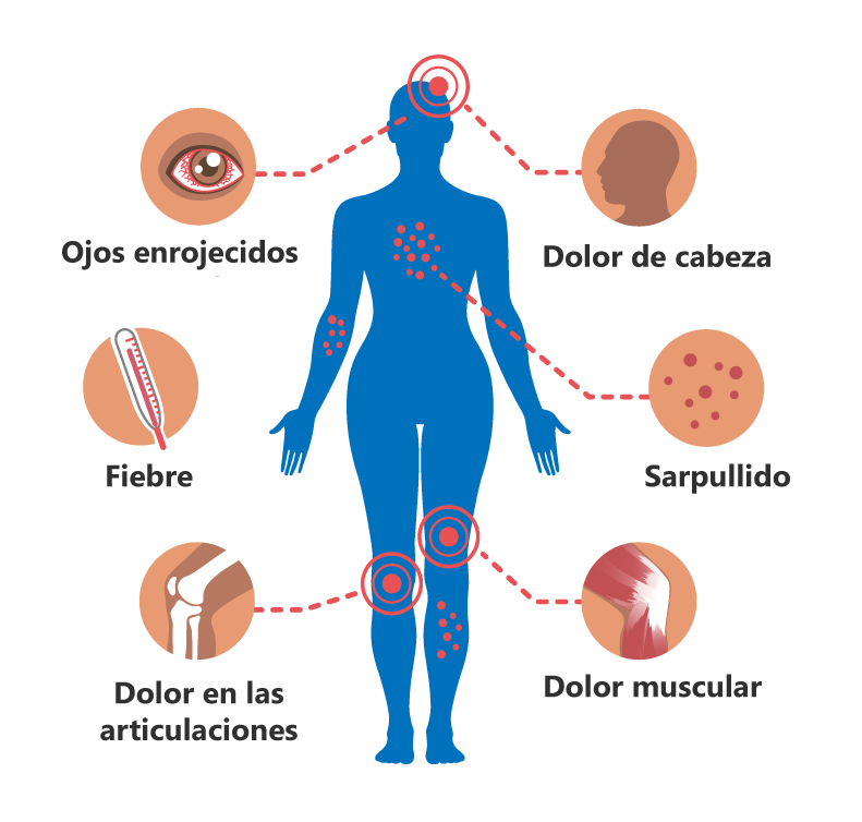 Zika-Symptoms-Graphic