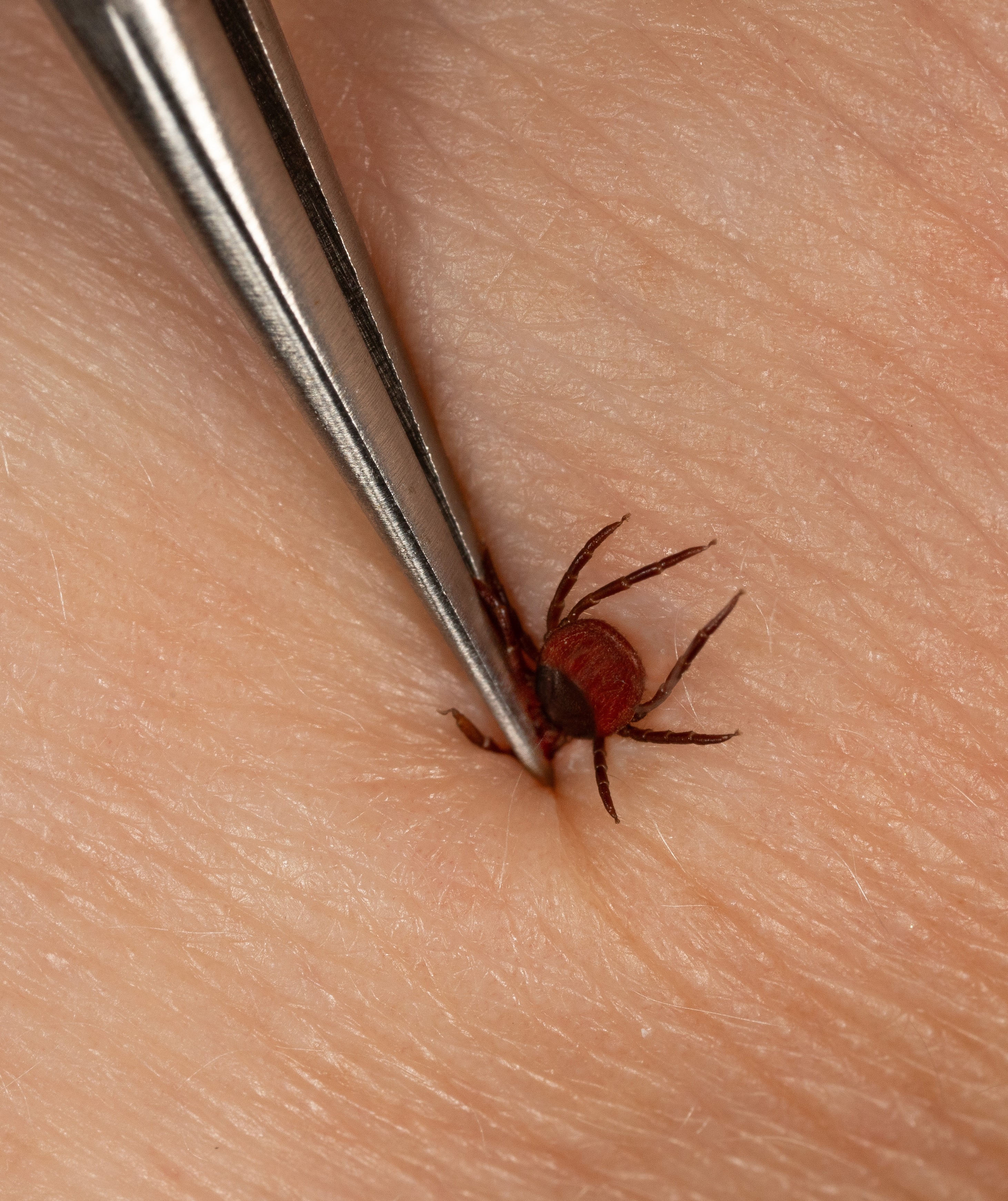 Removing embedded tick from the skin with forceps