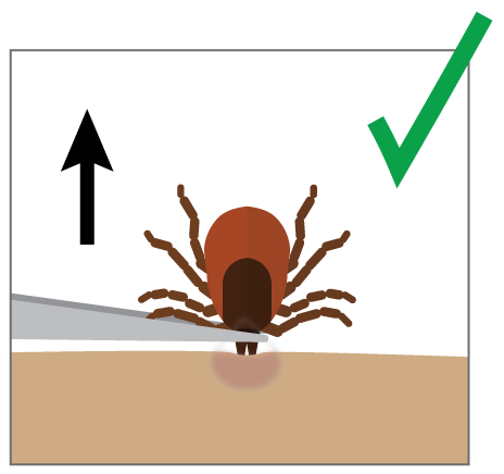 Tick-Removal