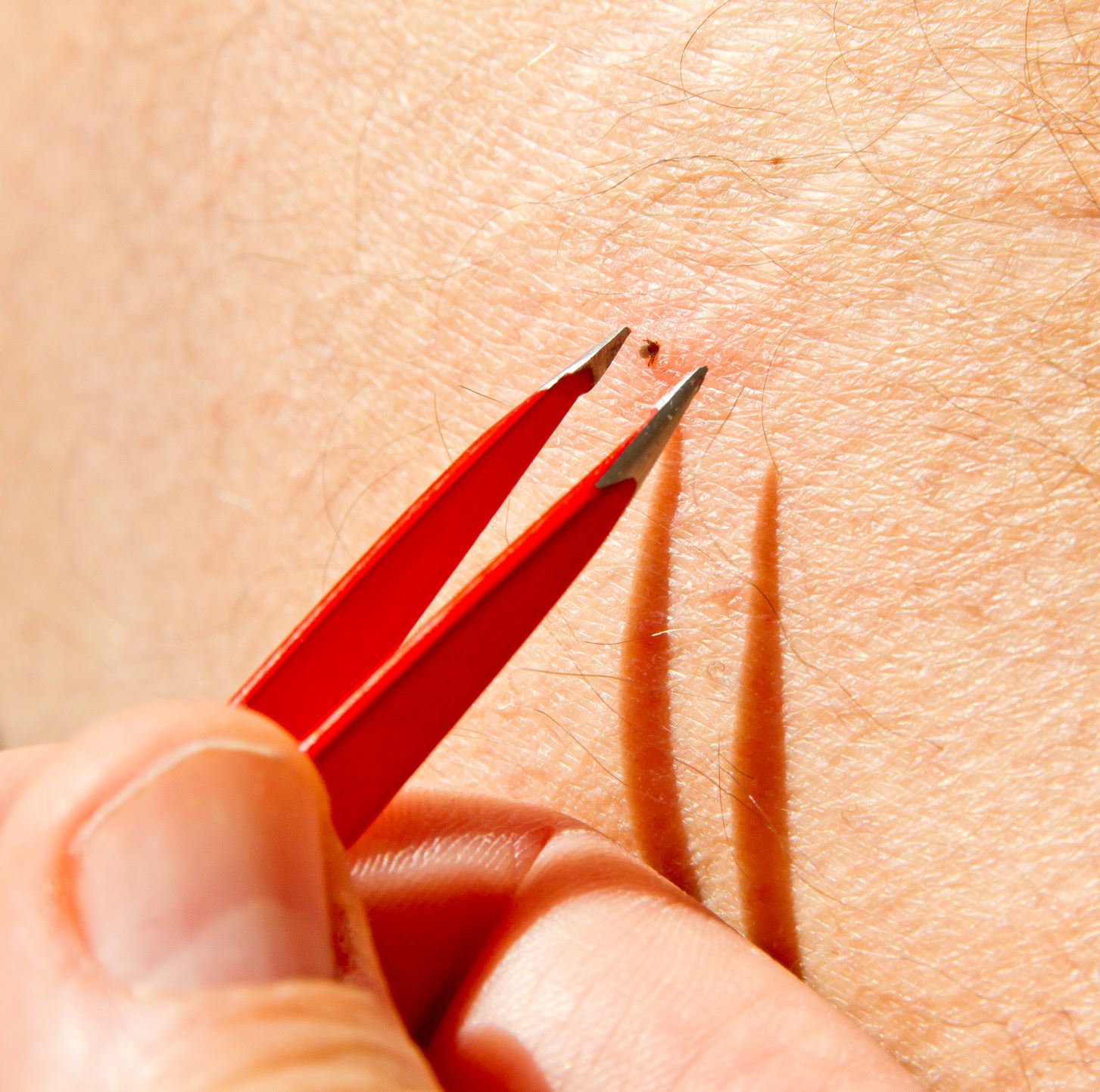 Use tweezers to remove ticks embedded in the skin.