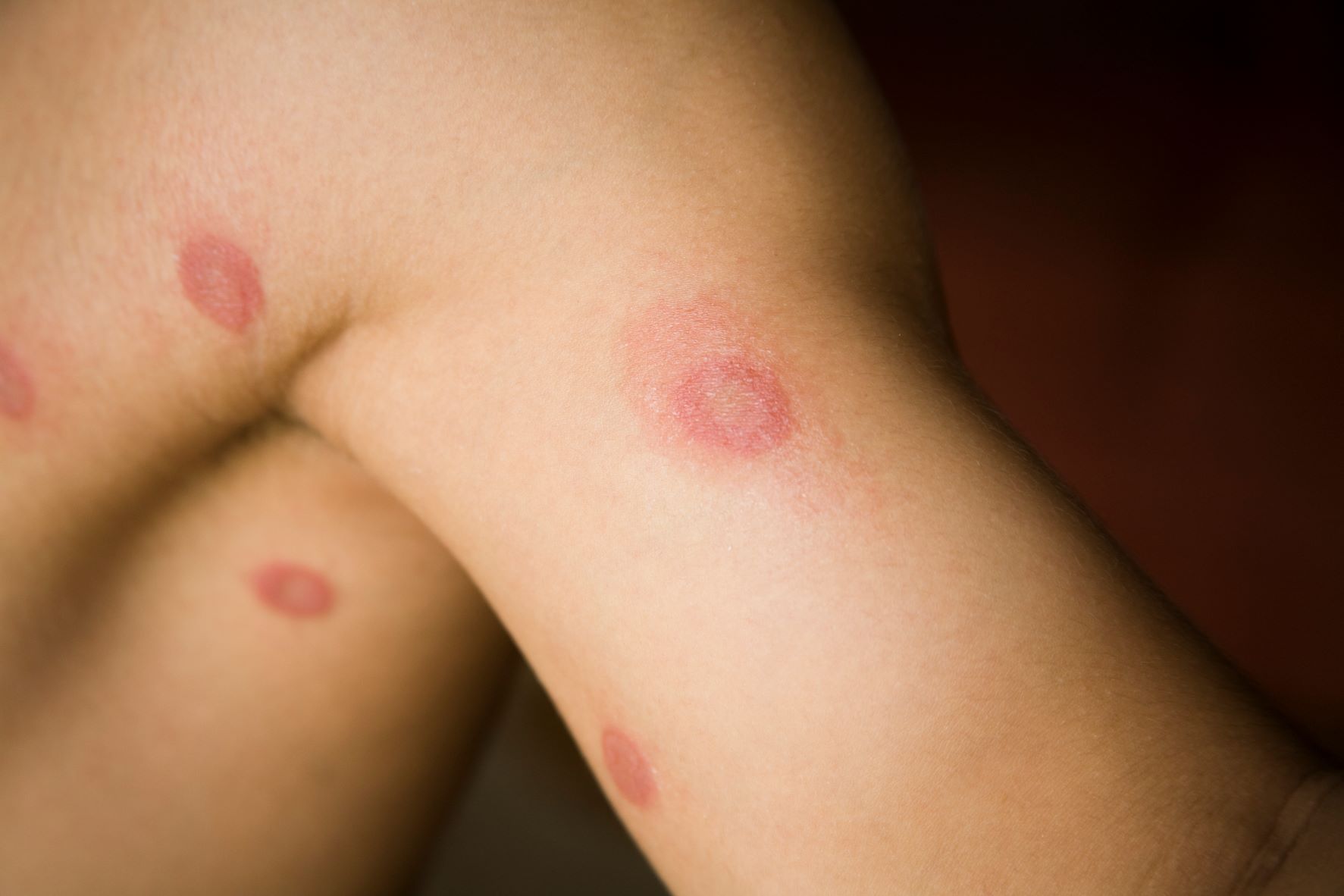 Ringworm rash on human skin